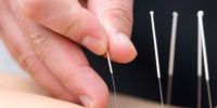 bigstock-acupuncture-12557702-1