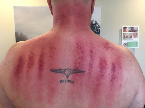 #1 Gua Sha Scraping Therapy in Montana Get Started photo